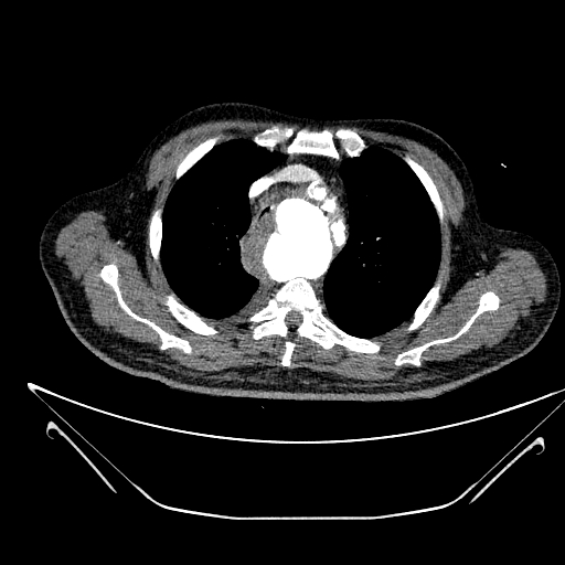 Aortic arch aneurysm (Radiopaedia 84109-99365 B 175).jpg