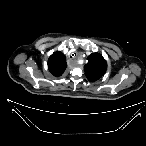 Aortic arch aneurysm (Radiopaedia 84109-99365 C 16).jpg