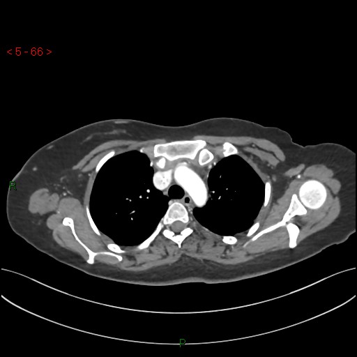 File:Aortic arch origin of left vertebral artery (Radiopaedia 51520-57286 A 65).jpg
