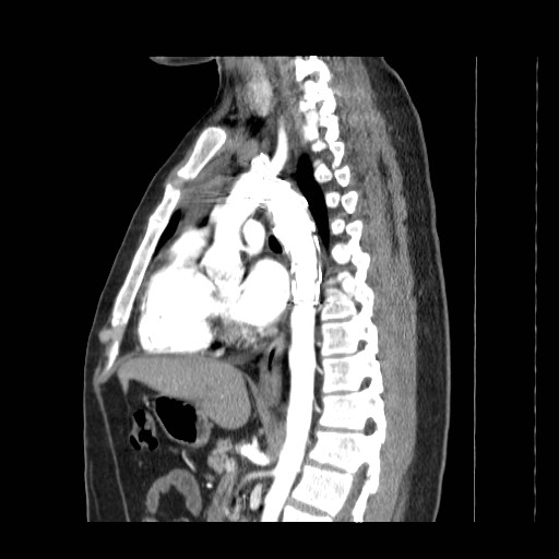 File:Aortic arch stent (Radiopaedia 30030-30595 E 11).jpg