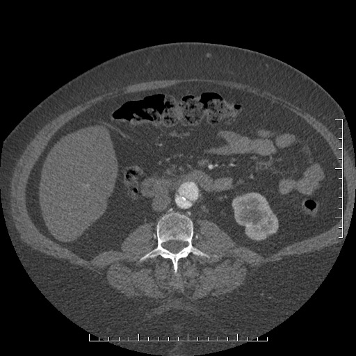 File:Aortic dissection- Stanford A (Radiopaedia 35729-37268 C 13).jpg
