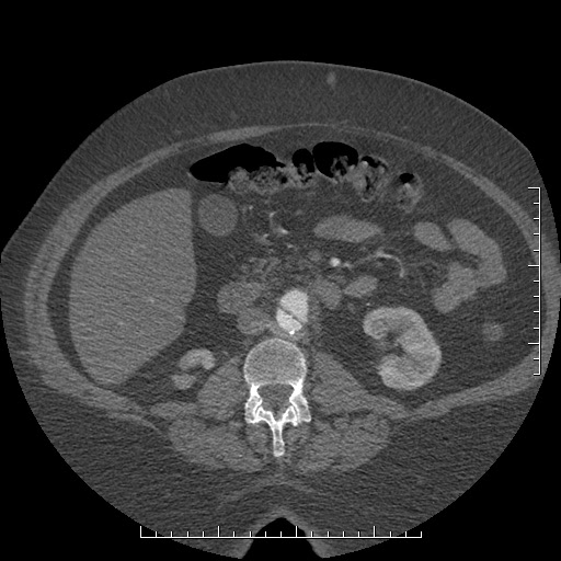 File:Aortic dissection- Stanford A (Radiopaedia 35729-37268 C 7).jpg