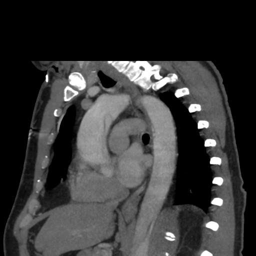 File:Aortic dissection- Stanford A (Radiopaedia 37759-39664 D 15).png