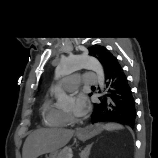 File:Aortic dissection- Stanford A (Radiopaedia 37759-39664 D 20).png