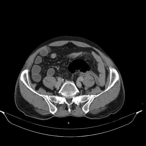 File:Aortic dissection- Stanford type A (Radiopaedia 22085-22085 Axial C+ delayed 38).jpg