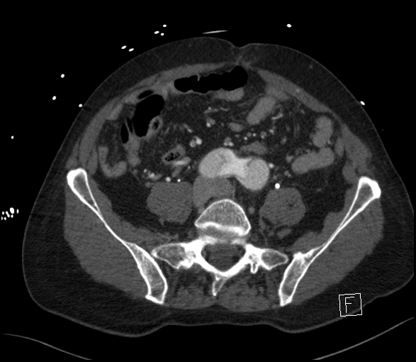 Aortic dissection (CTPA) (Radiopaedia 75506-86750 E 103).jpg