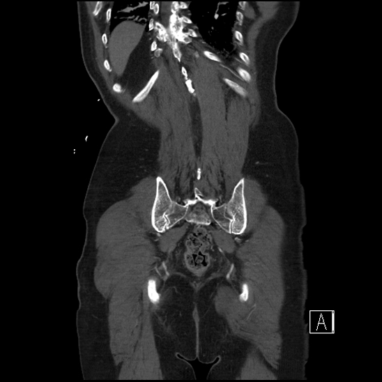 File:Aortic dissection (CTPA) (Radiopaedia 75506-86750 F 65).jpg