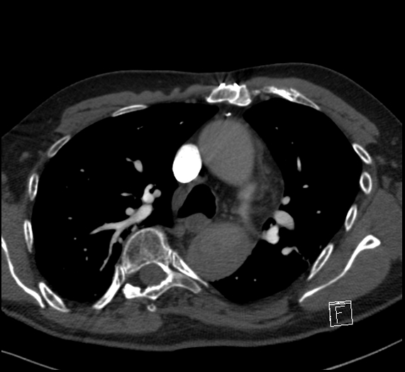 File:Aortic dissection (CTPA) (Radiopaedia 75506-86751 Axial C+ CTPA 53).jpg