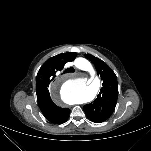 Aortic dissection (Radiopaedia 27466-27665 C+ arterial phase 75).jpg