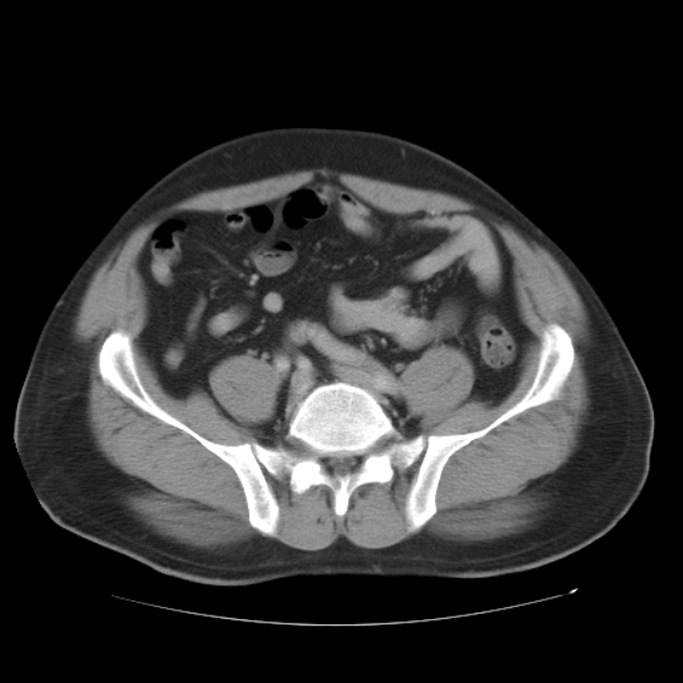 Aortic dissection (Radiopaedia 44411-48061 C 91).jpg