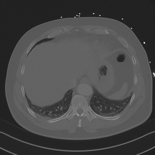 Aortic dissection (Radiopaedia 50763-56234 Axial bone window 83).png