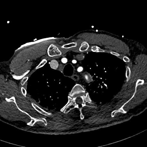File:Aortic dissection - DeBakey type II (Radiopaedia 64302-73082 A 19).png