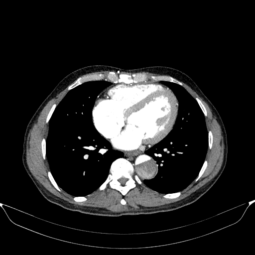 File:Aortic dissection - Stanford type A (Radiopaedia 83418-98500 A 42).jpg