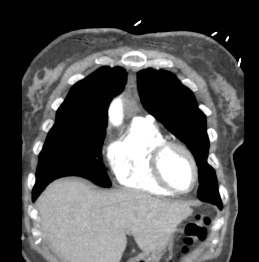 File:Aortic dissection - Stanford type B (Radiopaedia 50171-55512 B 20).png