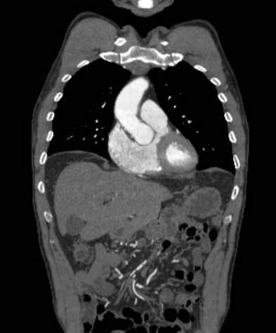 File:Aortic dissection - Stanford type B (Radiopaedia 73648-84437 B 38).jpg