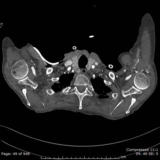 File:Aortic dissection with extension into aortic arch branches (Radiopaedia 64402-73204 B 49).jpg