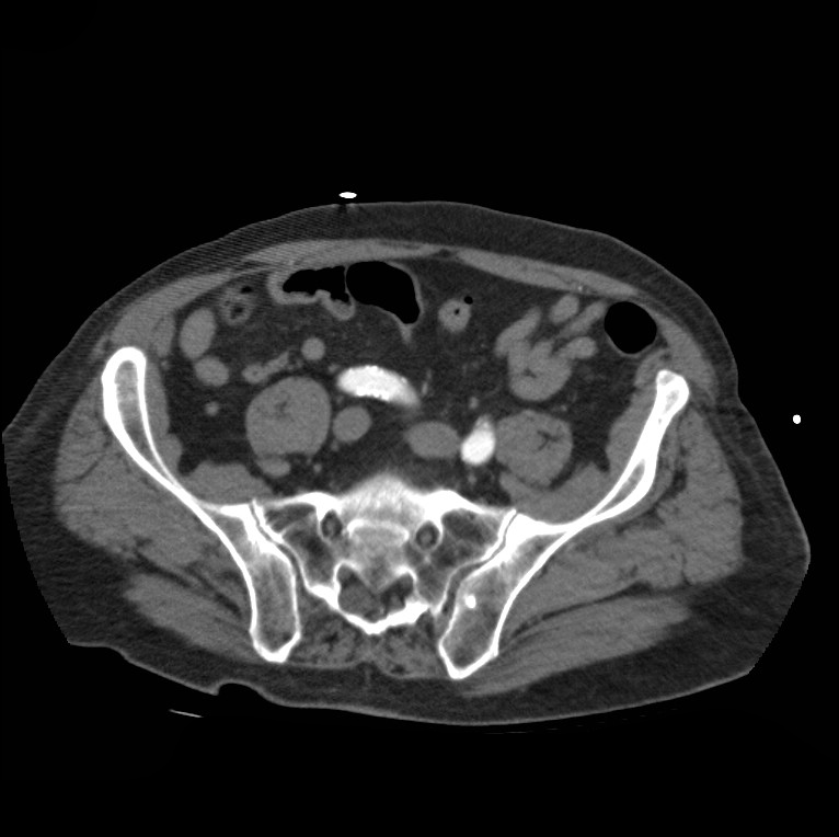 Aortic dissection with rupture into pericardium (Radiopaedia 12384-12647 A 76).jpg