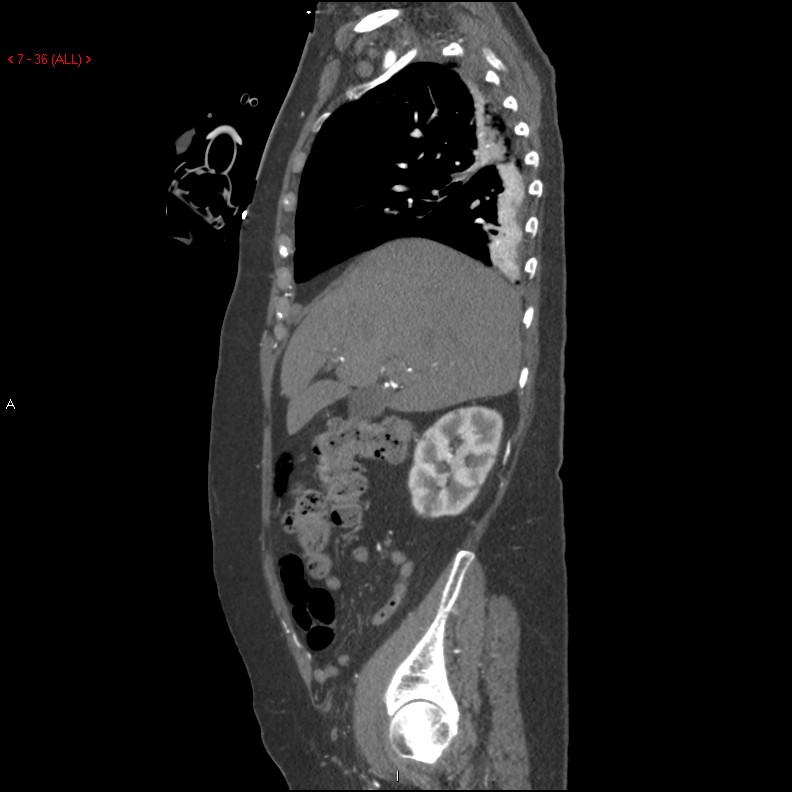 Aortic intramural hematoma (Radiopaedia 27746-28001 C 5).jpg