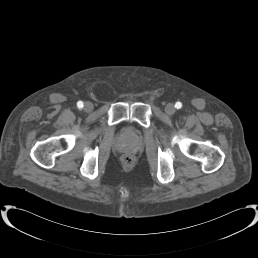 Aortic intramural hematoma (Radiopaedia 34260-35540 B 95).png