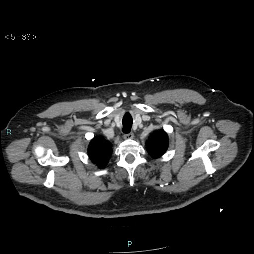 File:Aortic intramural hematoma (Radiopaedia 48463-53380 C 18).jpg
