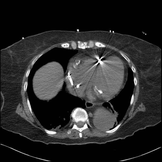 Aortic intramural hematoma with dissection and intramural blood pool (Radiopaedia 77373-89491 Axial non-contrast 68).jpg