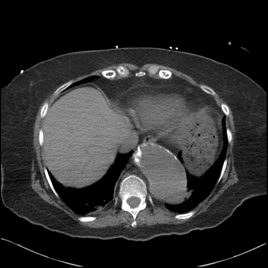 File:Aortic intramural hematoma with dissection and intramural blood pool (Radiopaedia 77373-89491 Axial non-contrast 78).jpg