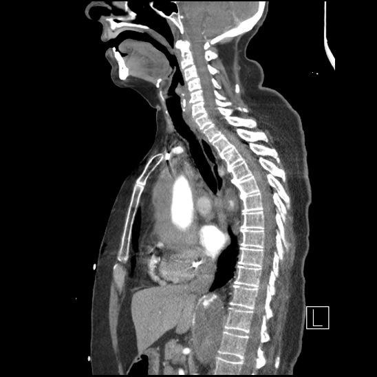 File:Aortic intramural hematoma with dissection and intramural blood pool (Radiopaedia 77373-89491 D 42).jpg