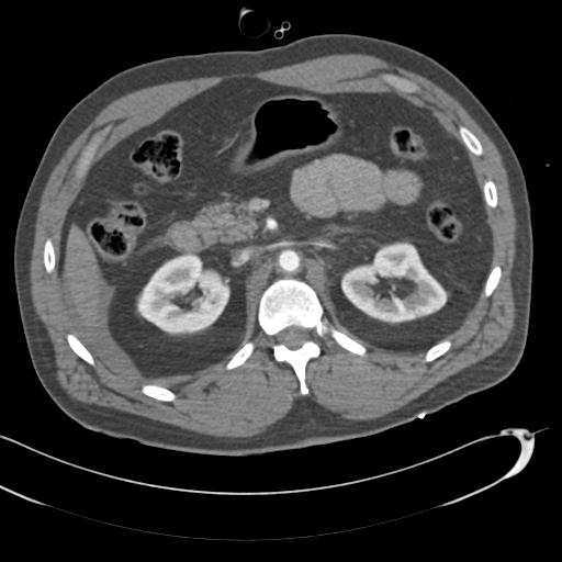 Aortic transection, diaphragmatic rupture and hemoperitoneum in a complex multitrauma patient (Radiopaedia 31701-32622 A 101).jpg