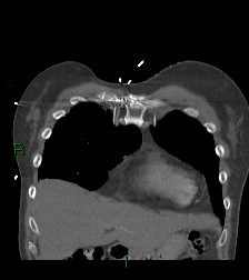File:Aortic valve endocarditis (Radiopaedia 87209-103485 D 58).jpg