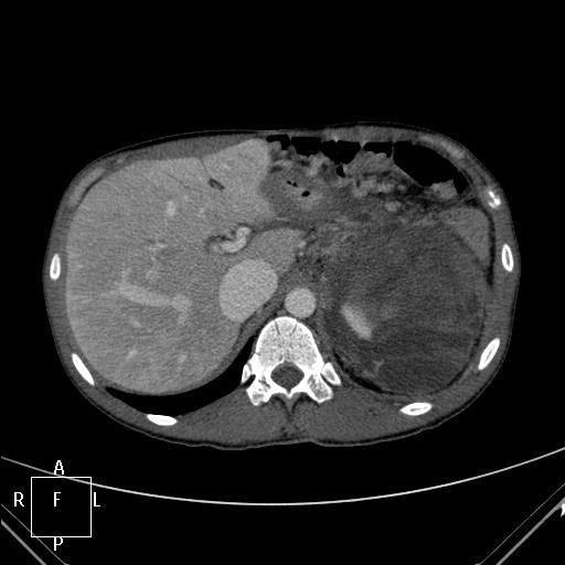 File:Aorto-left renal vein fistula (Radiopaedia 45534-49628 A 1).jpg
