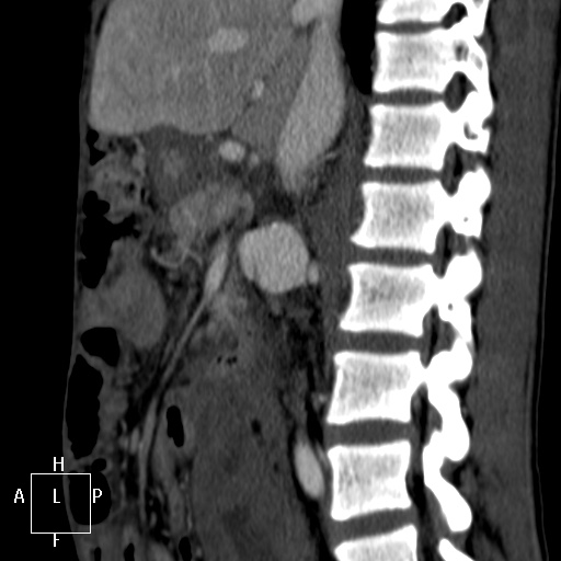 Aorto-left renal vein fistula (Radiopaedia 45534-49628 C 28).jpg