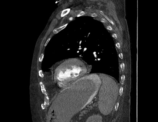 Aortoesophageal fistula with endovascular repair (Radiopaedia 73781-84592 Sagittal C+ CTPA 144).jpg