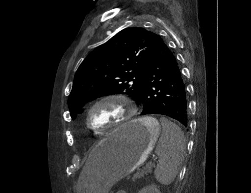 Aortoesophageal fistula with endovascular repair (Radiopaedia 73781-84592 Sagittal C+ CTPA 149).jpg