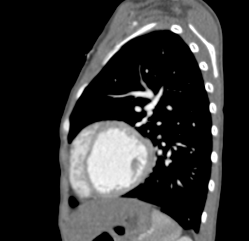 File:Aortopulmonary window, interrupted aortic arch and large PDA giving the descending aorta (Radiopaedia 35573-37074 C 42).jpg