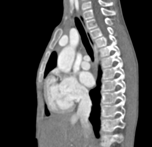 File:Aortopulmonary window, interrupted aortic arch and large PDA giving the descending aorta (Radiopaedia 35573-37074 C 9).jpg