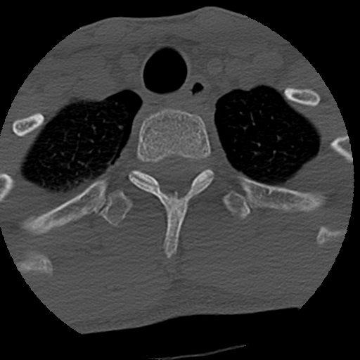 Apical pneumothorax on cervical spine CT (Radiopaedia 45343-49368 Axial bone window 90).jpg