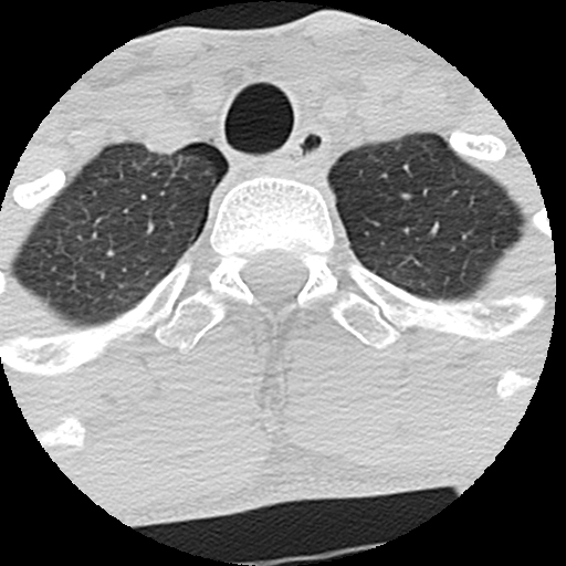File:Apical pneumothorax on cervical spine CT (Radiopaedia 45343-49368 Axial lung window 12).jpg