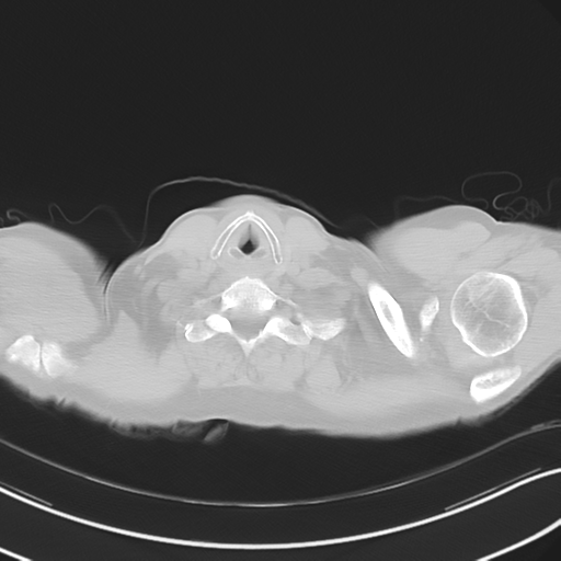 Apical pulmonary metastasis (Radiopaedia 46338-50754 Axial non-contrast 3).png