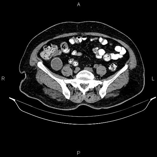 Appendiceal mucocele (Radiopaedia 82952-97298 A 73).jpg