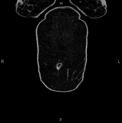 Appendiceal mucocele (Radiopaedia 82952-97298 C 5).jpg