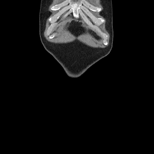 Appendiceal mucocoele (Radiopaedia 47464-52057 Coronal non-contrast 2).jpg