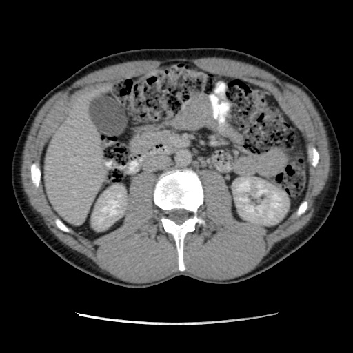 Appendicitis complicated by post-operative collection (Radiopaedia 35595-37113 A 30).jpg