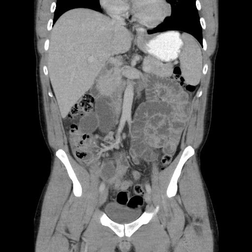 Appendicitis complicated by post-operative collection (Radiopaedia 35595-37114 B 26).jpg