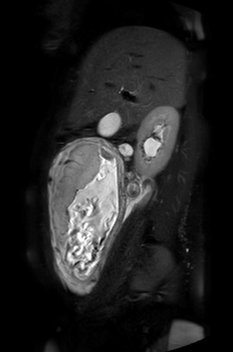 Appendicitis in gravida (MRI) (Radiopaedia 89433-106395 Sagittal T2 SPAIR 43).jpg