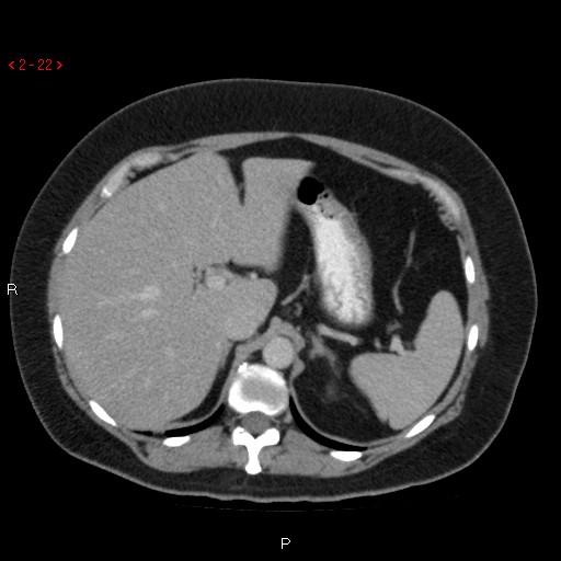 File:Appendicitis with microperforation- promontoric type (Radiopaedia 27268-27442 C 10).jpg