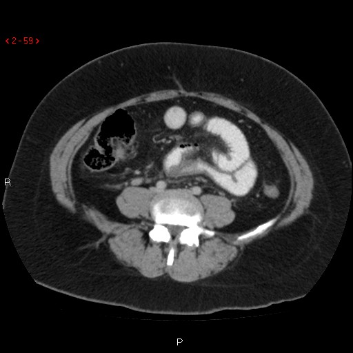 File:Appendicitis with microperforation- promontoric type (Radiopaedia 27268-27442 C 47).jpg