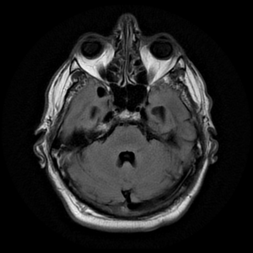 File:Aqueduct stenosis with corpus callosum hypoattenuation post shunting (Radiopaedia 37212-38969 Axial FLAIR 6).png