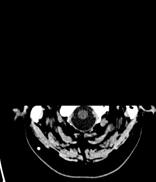 File:Aqueduct stenosis with corpus callosum hypoattenuation post shunting (Radiopaedia 37212-38973 Axial non-contrast 2).png