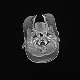 Aqueductal stenosis (Radiopaedia 73974-84802 Axial T1 C+ 30).jpg