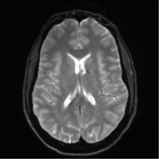 Arachnoid cyst - cerebellopontine angle (Radiopaedia 59689-67083 Axial DWI 21).png
